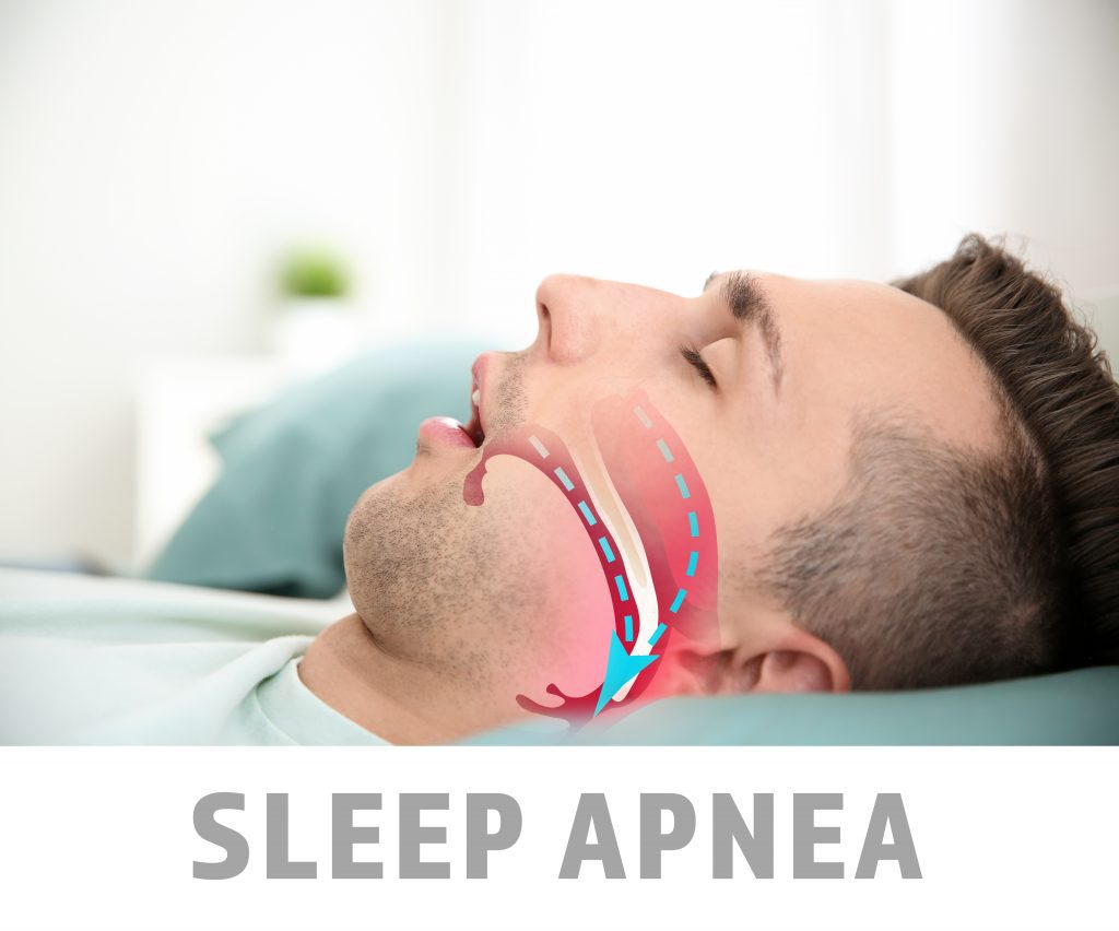 Man sleeping on back with sleep apnea illustration, for treatment contact Crown Point dentist.