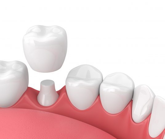 Getting a Dental Crown? Here’s What to Expect