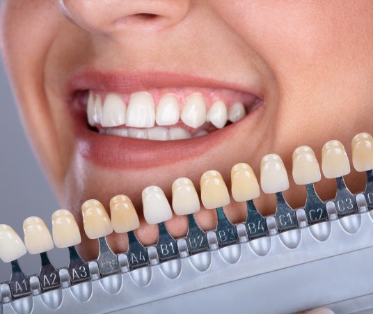 Will My Dental Crown Match the Color of My Teeth?