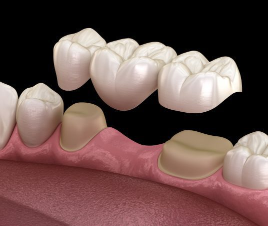How Many Teeth Can a Dental Bridge Replace? 