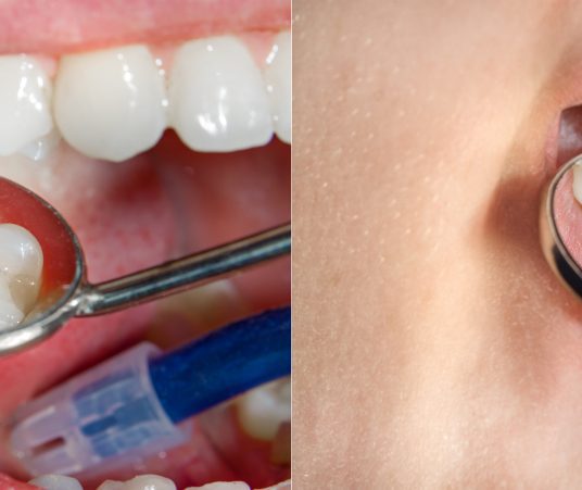 How Long Do Dental Crowns Last? 