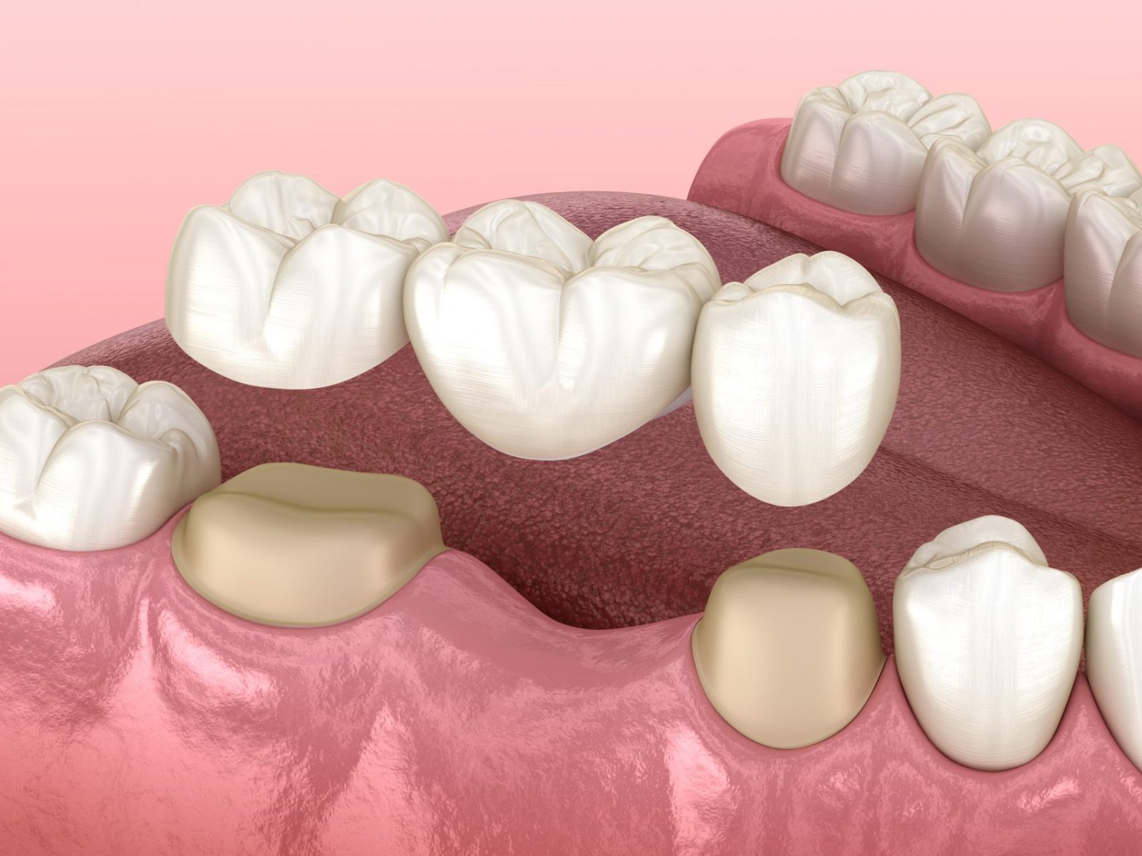Is a Dental Bridge Permanent?