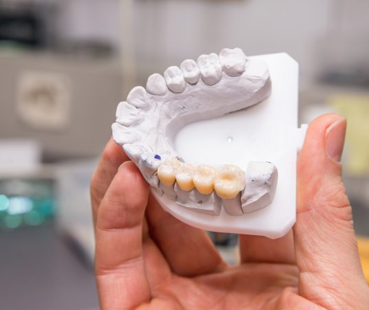 What Is a Dental Bridge? 