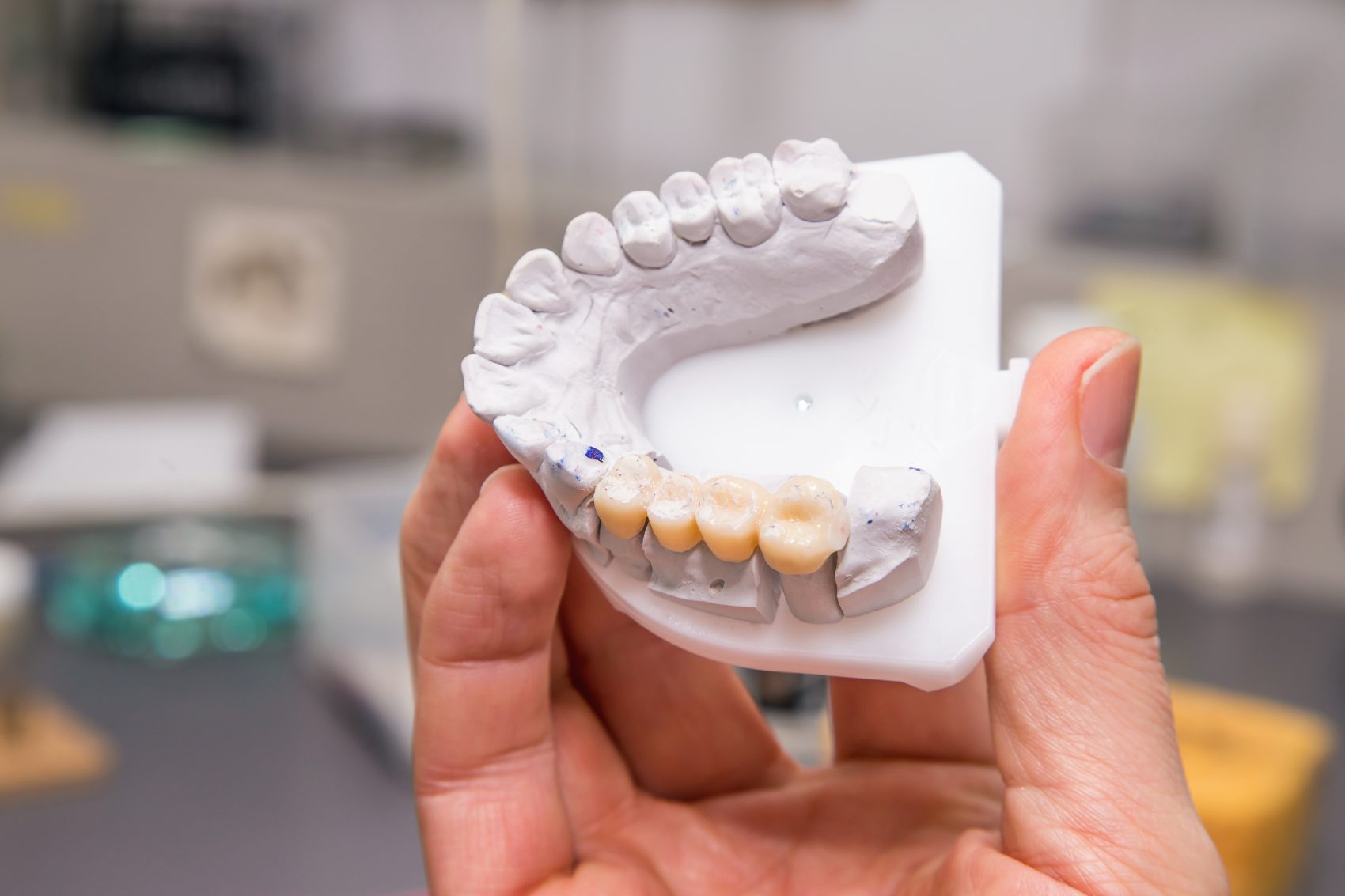 What Is a Dental Bridge?
