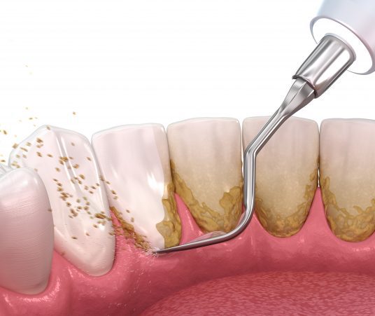 How a Professional Deep Cleaning Treats Gum Disease 