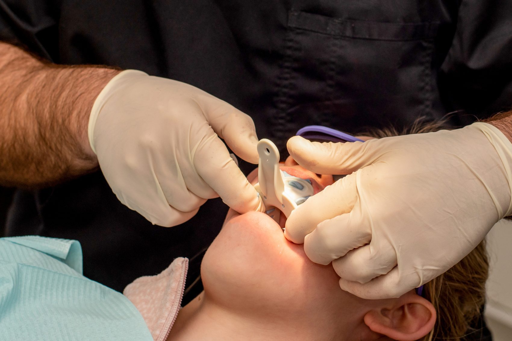 Preparing for Dental Bridges: What to Expect