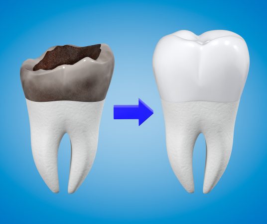 Advantages to Dental Crowns 