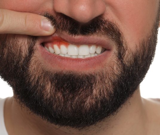 Gum Disease Prevention