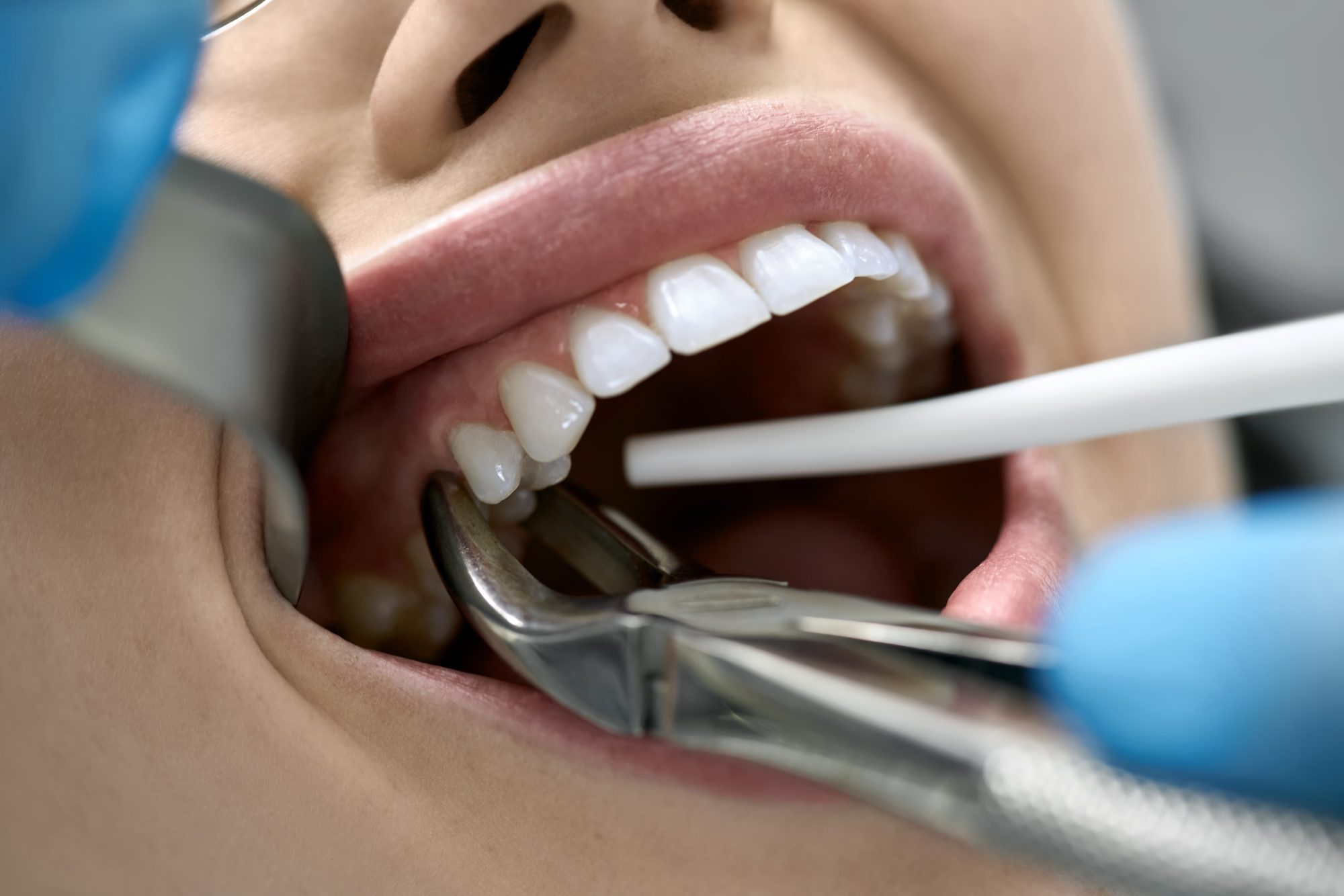 What Should I Expect During a Tooth Extraction?