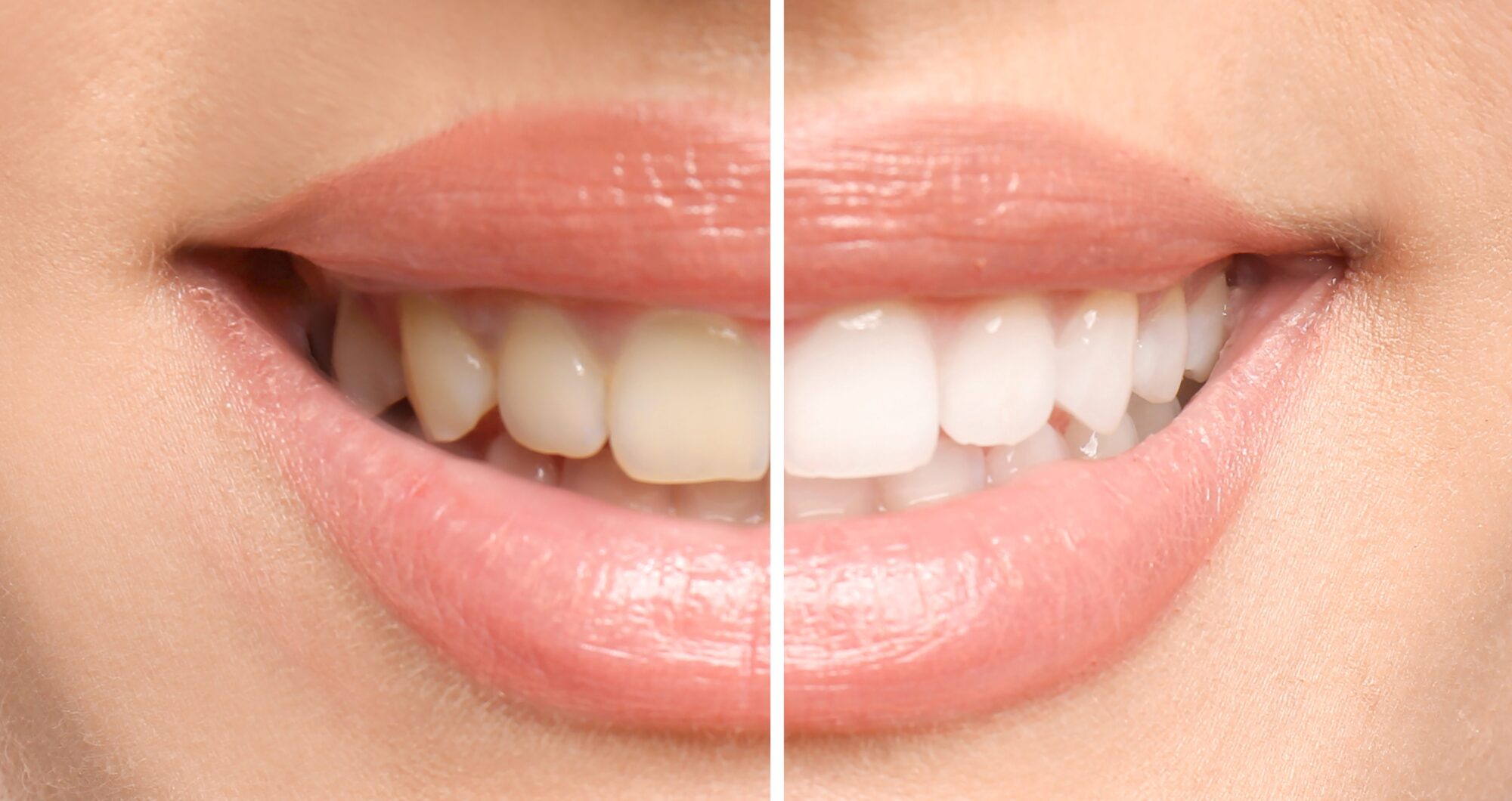 How Can I Combat Tooth Discoloration?