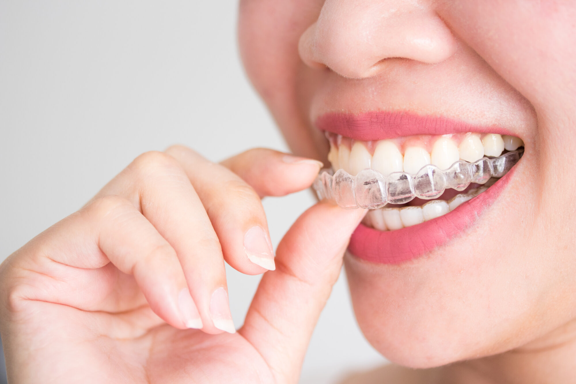 How Do You Properly Care for Your Invisible Orthodontics?