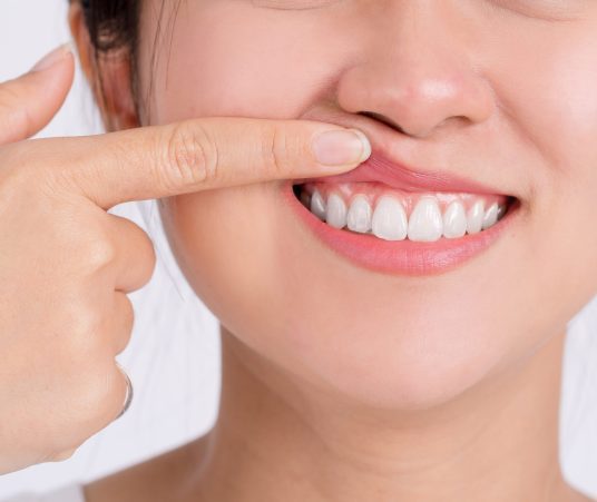 How Can You Avoid an Abscessed Tooth?
