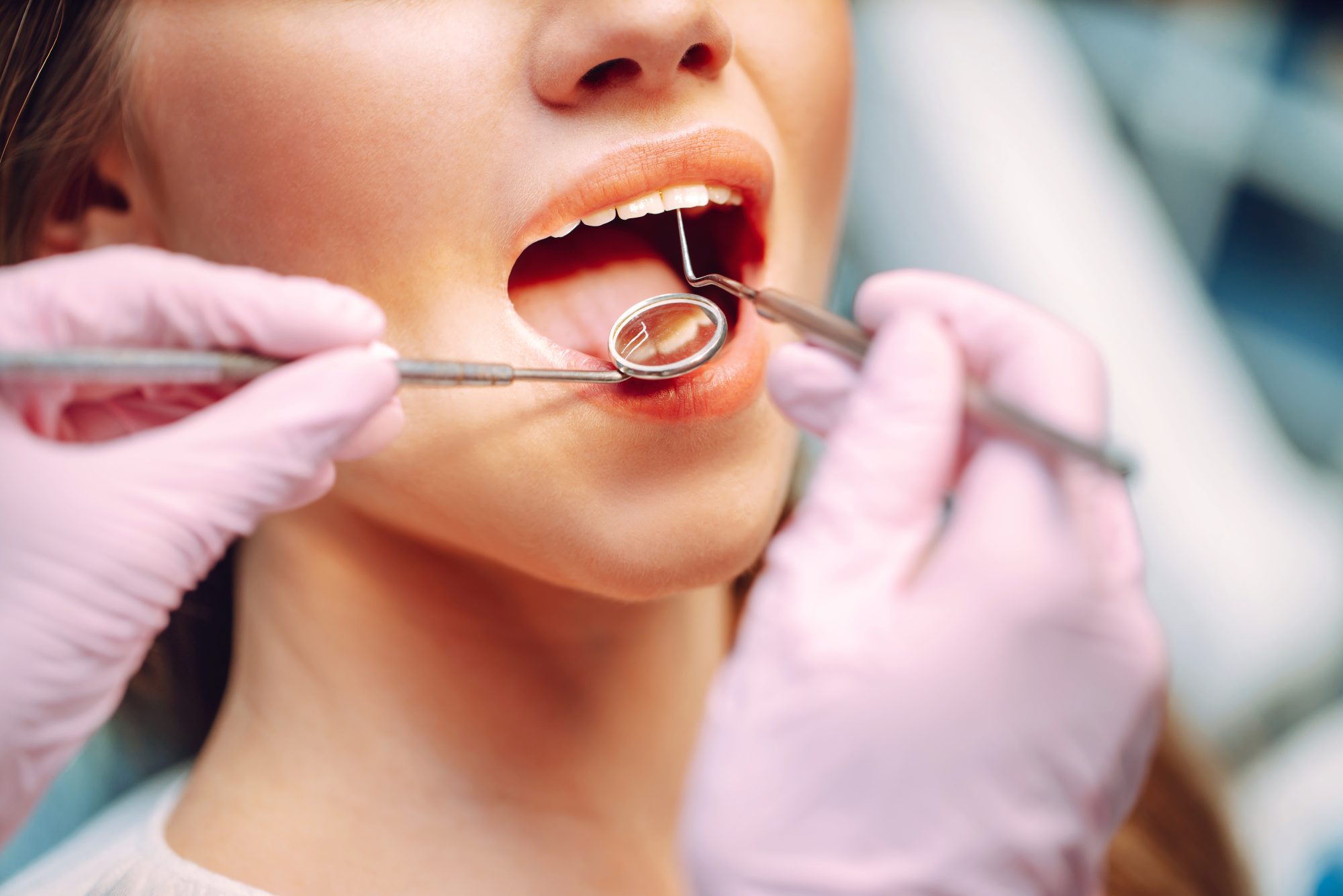 Why Do I Keep Getting Cavities?