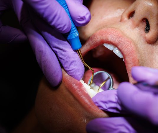 What Happens During a Dental Deep Cleaning?
