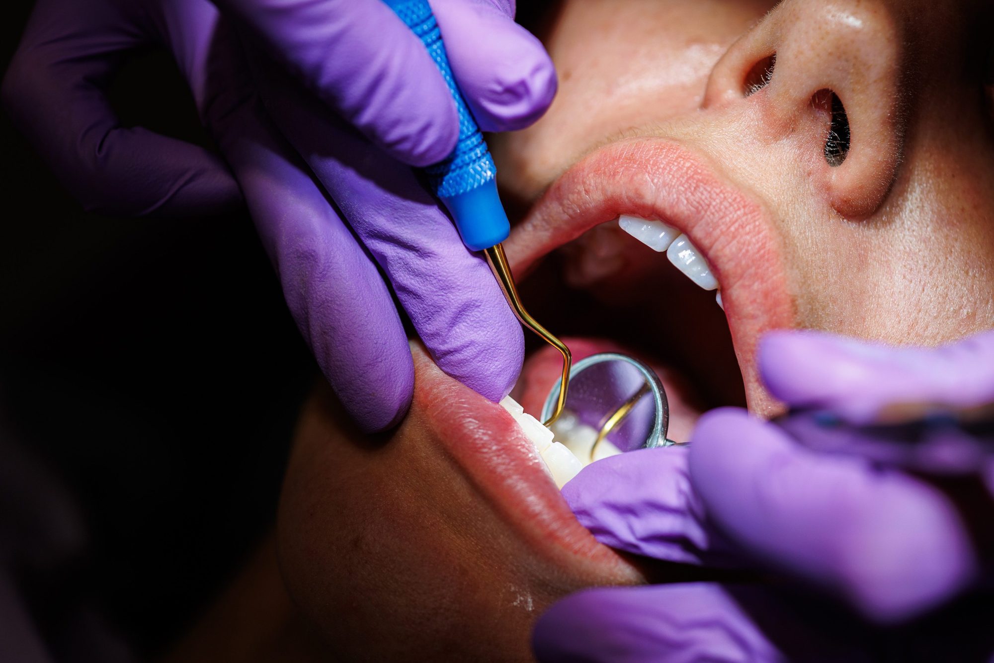 What Happens During a Dental Deep Cleaning?