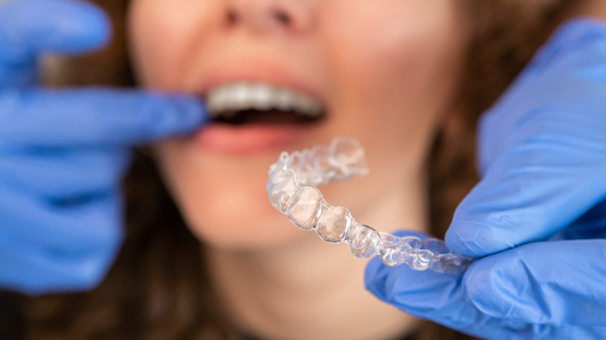 Are Invisible Orthodontics Worth It?