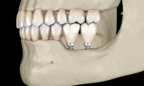 What Are the Best Smile Enhancement Options for Older Adults?