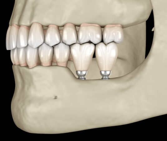What Are the Best Smile Enhancement Options for Older Adults?