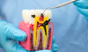 What Are the Signs You Might Need a Root Canal (Besides Pain)?