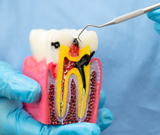 What Are the Signs You Might Need a Root Canal (Besides Pain)?