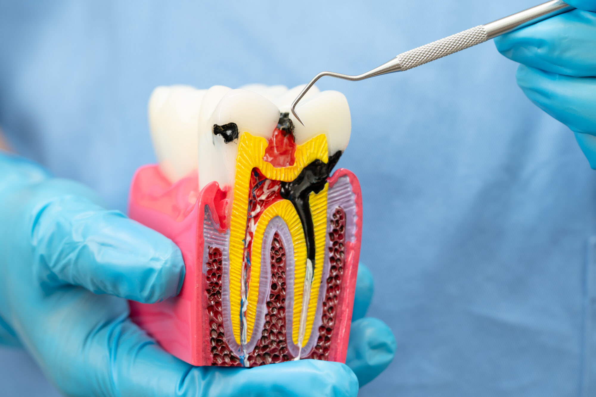 What Are the Signs You Might Need a Root Canal (Besides Pain)?