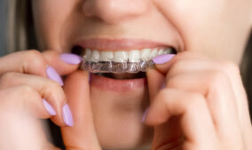 How Do Clear Aligners Affect Your Speech (and How Can You Adapt)?