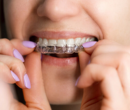 How Do Clear Aligners Affect Your Speech (and How Can You Adapt)?