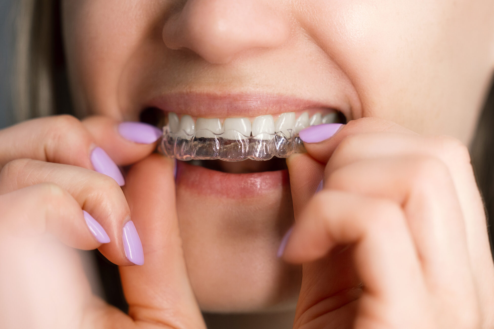 How Do Clear Aligners Affect Your Speech (and How Can You Adapt)?
