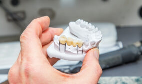 Can a Dental Bridge Be Repaired?