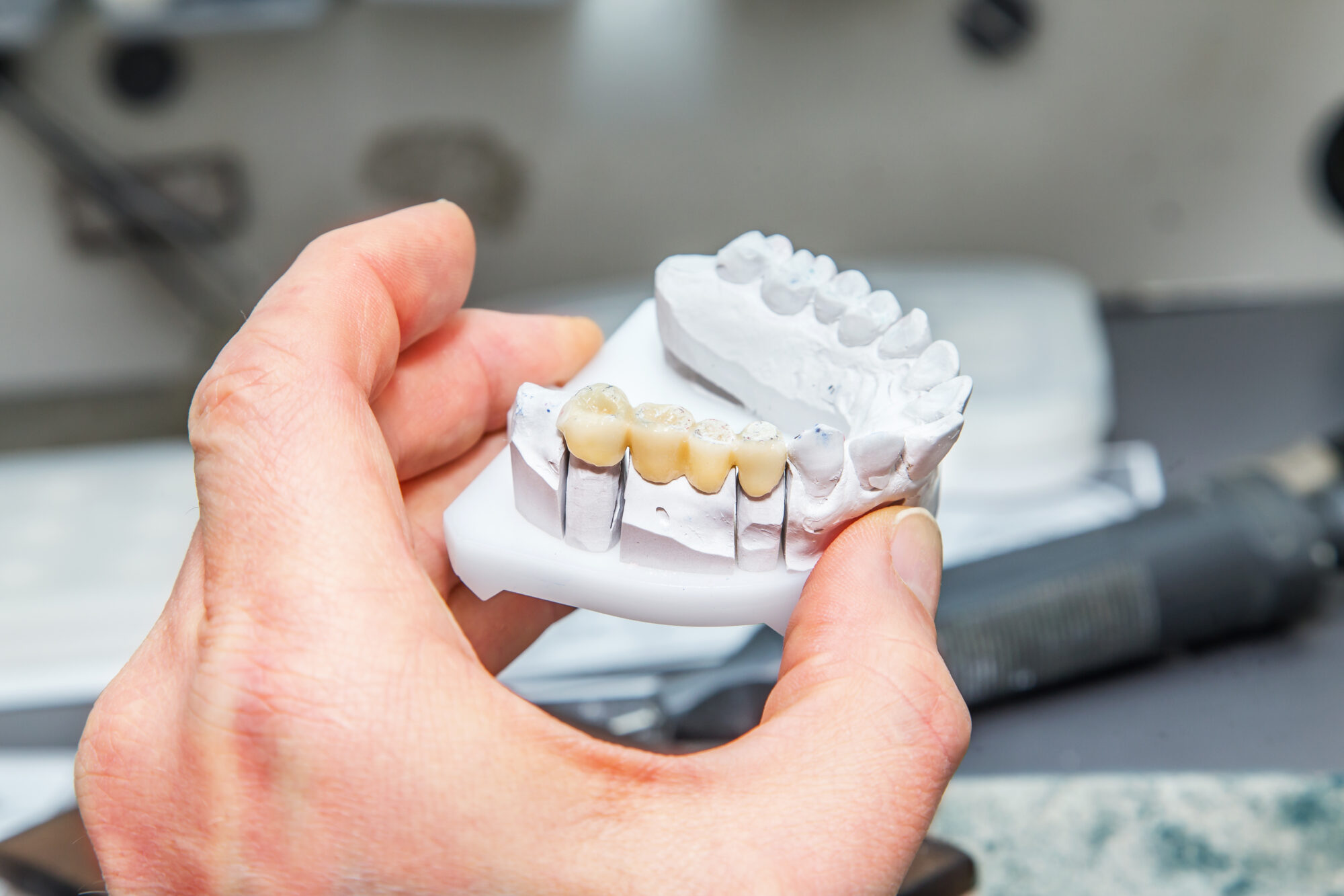 Can a Dental Bridge Be Repaired?