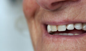 Why Does My Tooth Look Gray and Dark?