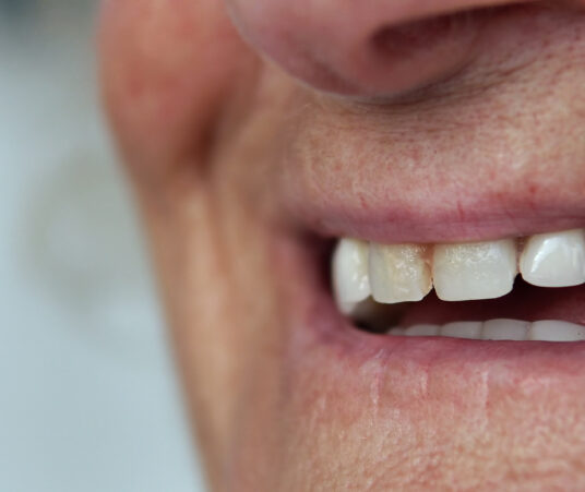 Why Does My Tooth Look Gray and Dark?