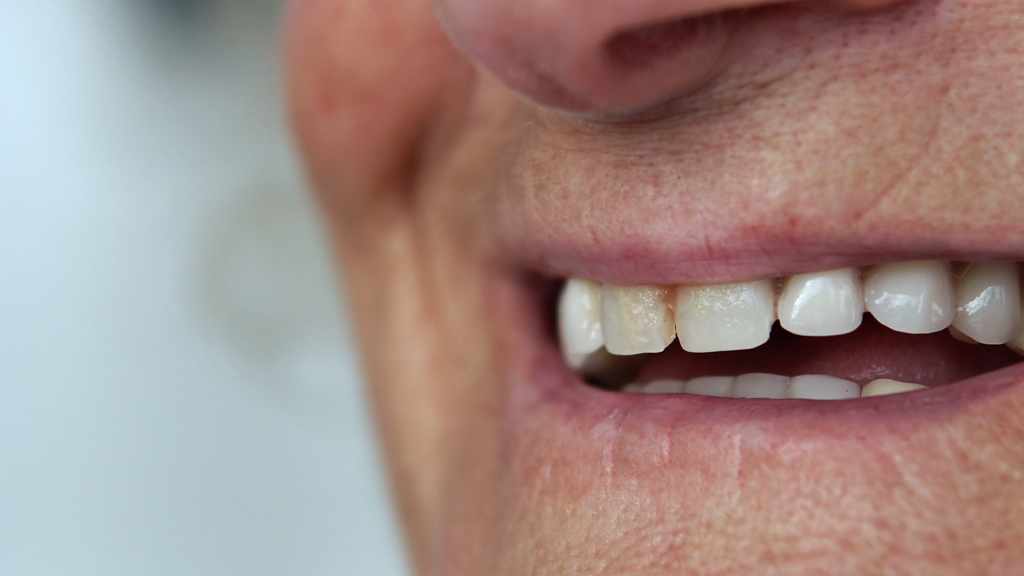 Why Does My Tooth Look Gray and Dark?