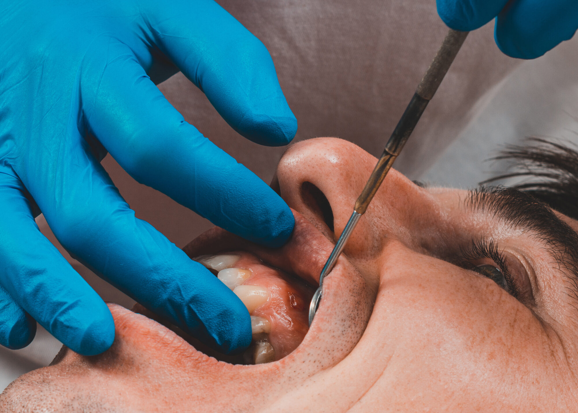 Can I Get Dental Implants if I Have Gum Disease?